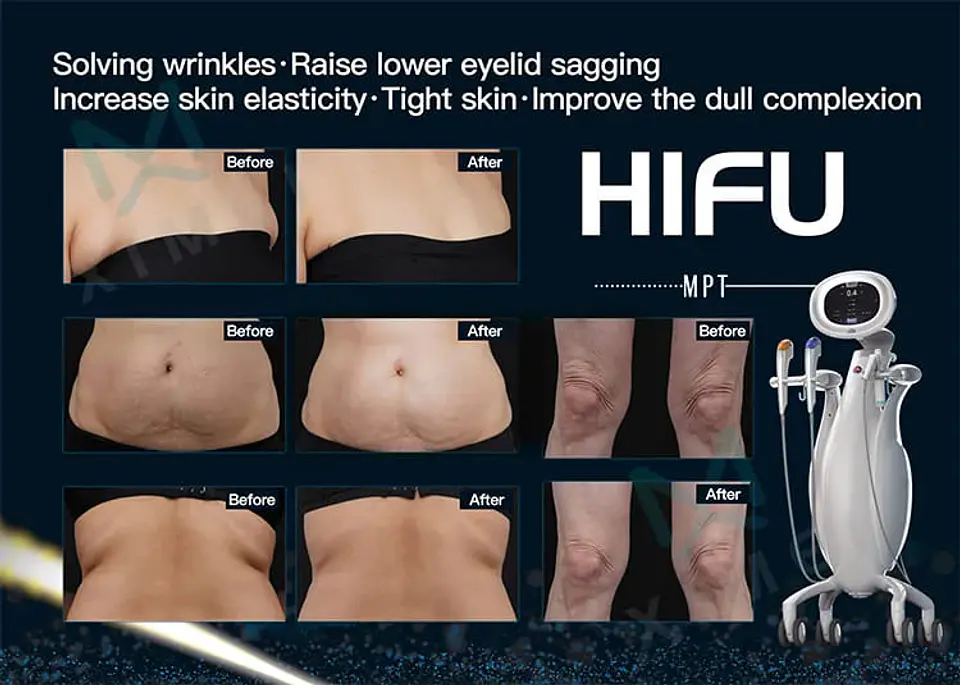 HIFU 12D MPT VERTICAL 12