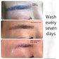 Equipo Picosegundo para eliminacion de Tatuajes, Peeling Hollywood y otros - Miniatura 9