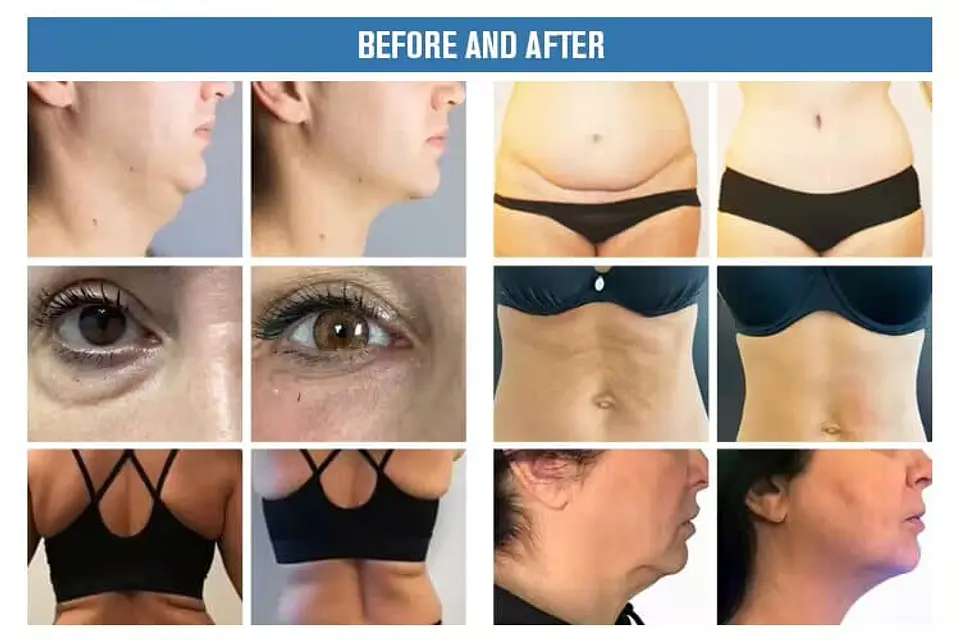 ENDOLIFT /Laser Diodo 1470nm 5