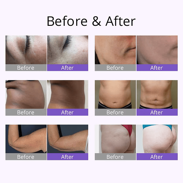 Cavitadora _cuerpo y rostro (NUEVO EQUIPO MULTIFUNCIONAL 4 EN 1) 3