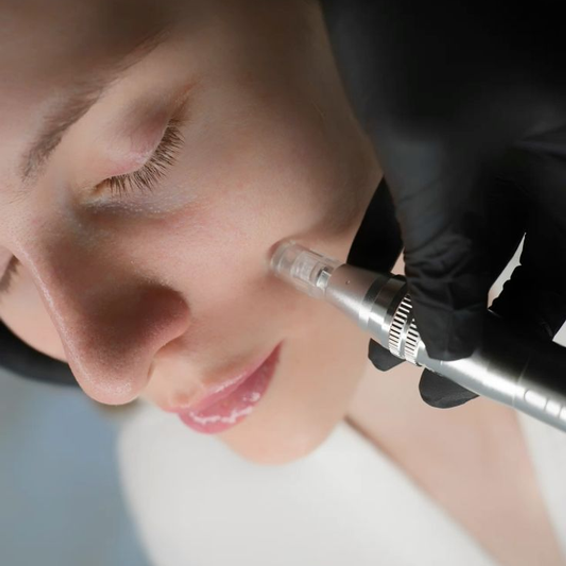 Aplicación de exosomas 3 zonas con Dermapen 1