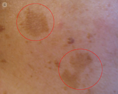 ¿Que alimentos debiera evitar si quiero alejarme de las manchas?