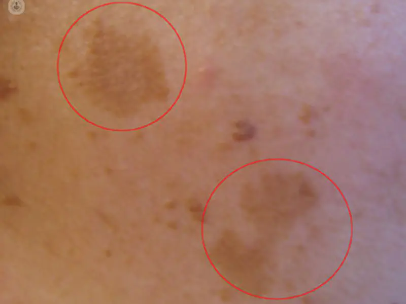 ¿Que alimentos debiera evitar si quiero alejarme de las manchas?