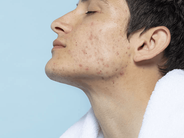 ¿Por qué sigues teniendo acné si usas cremas, te lavas la cara y haces todo “bien”?