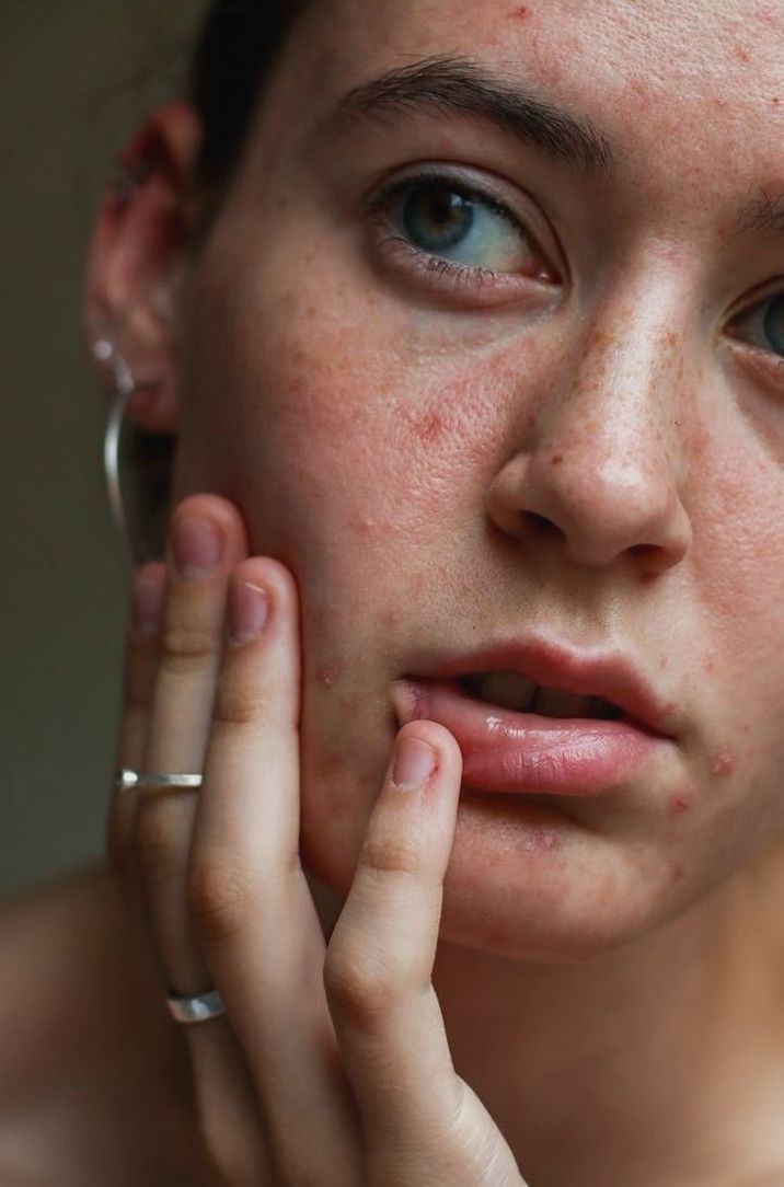 Acné: causas, inflamación y cómo el Zinc y el Omega-3 pueden ayudar a mejorar la piel