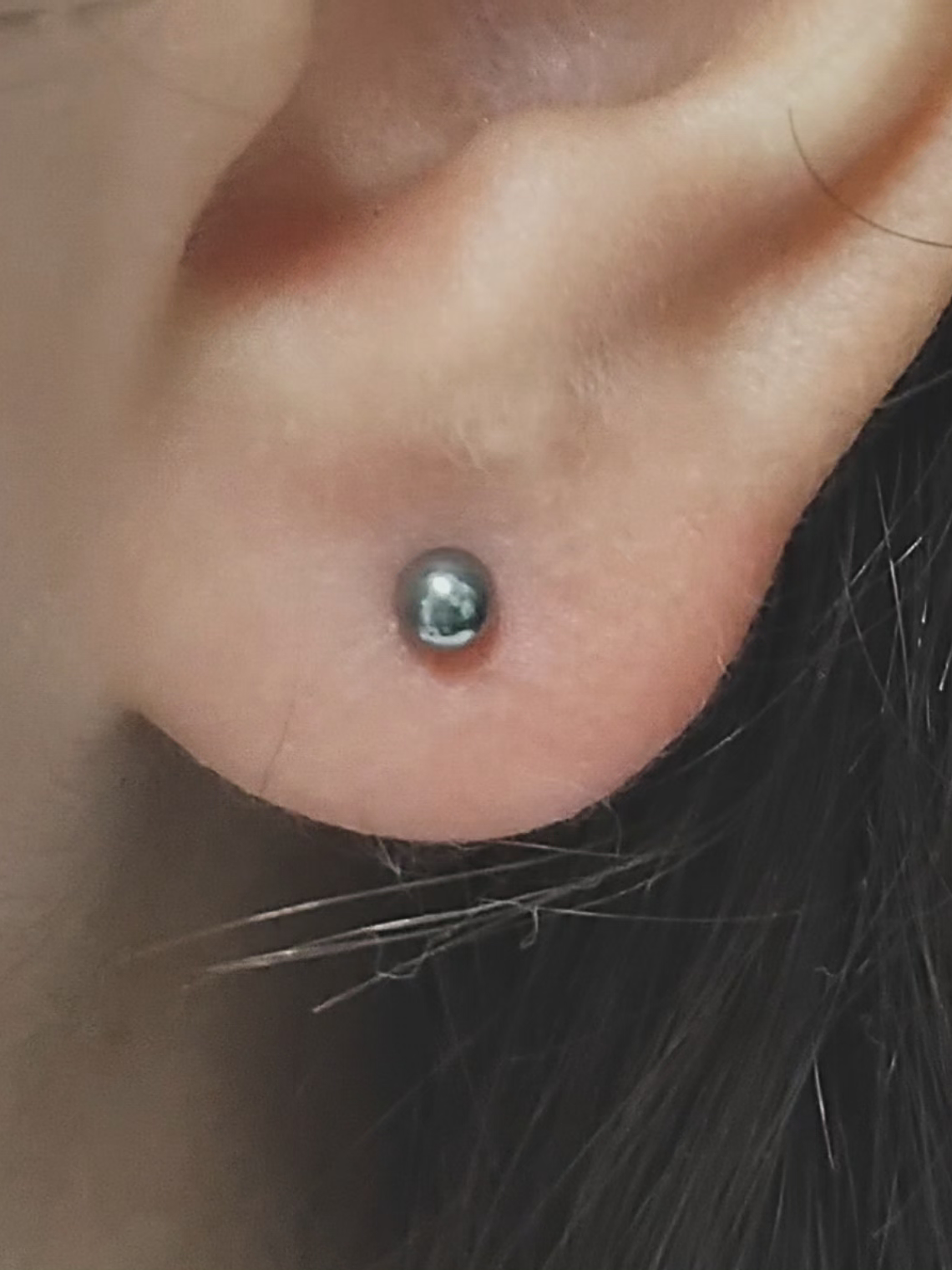 Perforación primer lóbulo  1