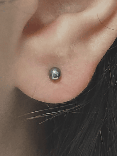 Perforación primer lóbulo 