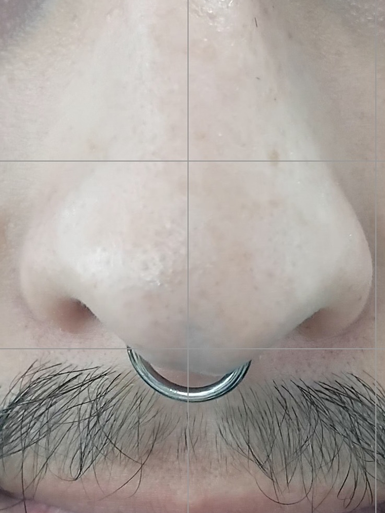 Septum perforación  2