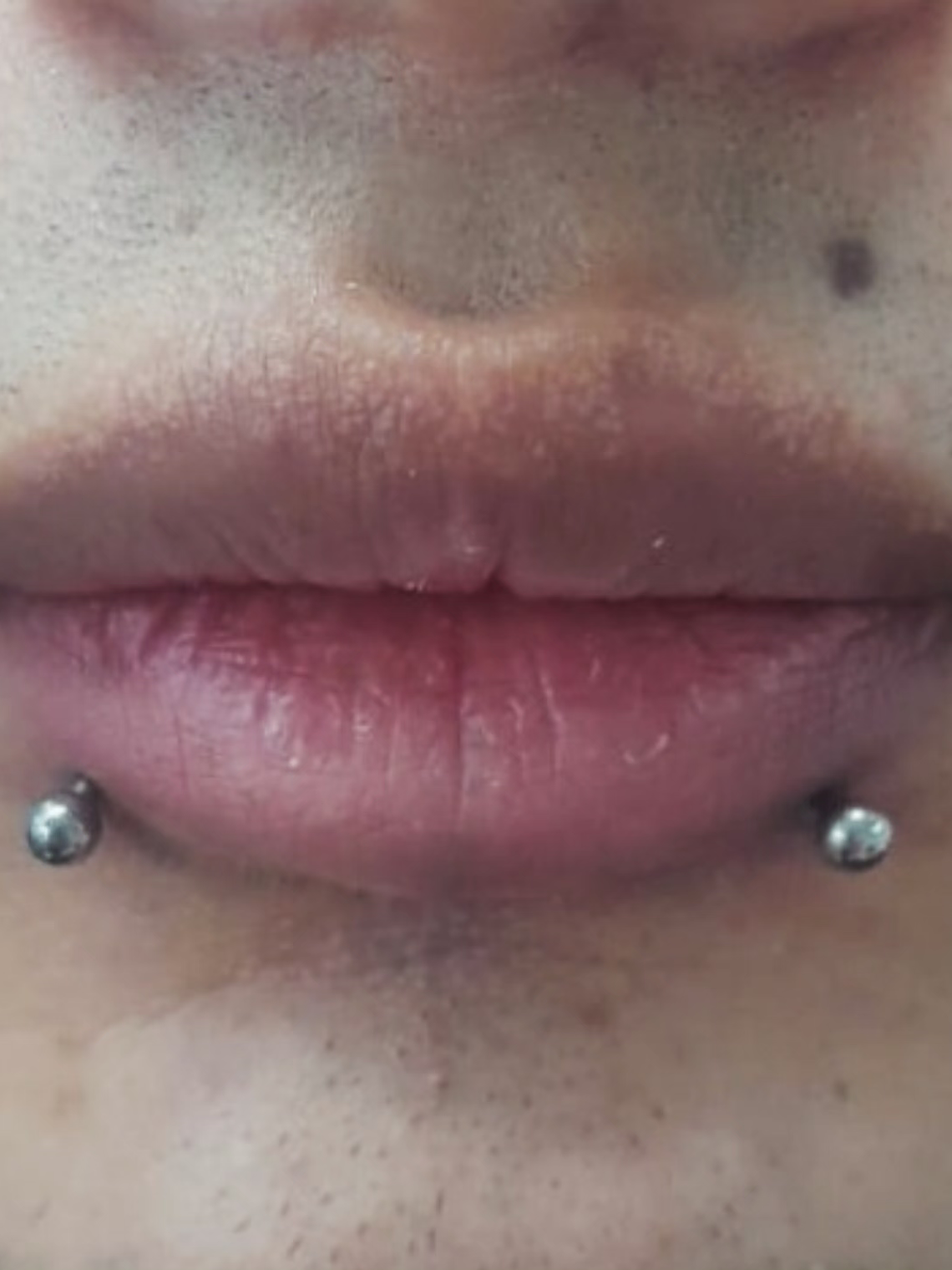 Perforación snake bite , (esferas o puntas 3m) 1