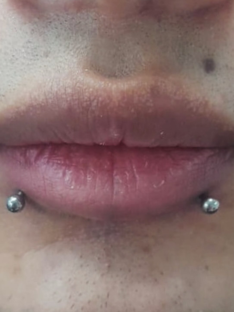 Perforación snake bite , (esferas o puntas 3m) 1
