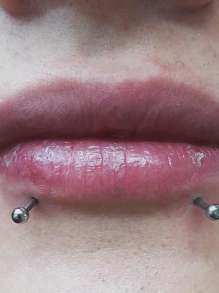 Perforación snake bite , (esferas o puntas 3m) 2