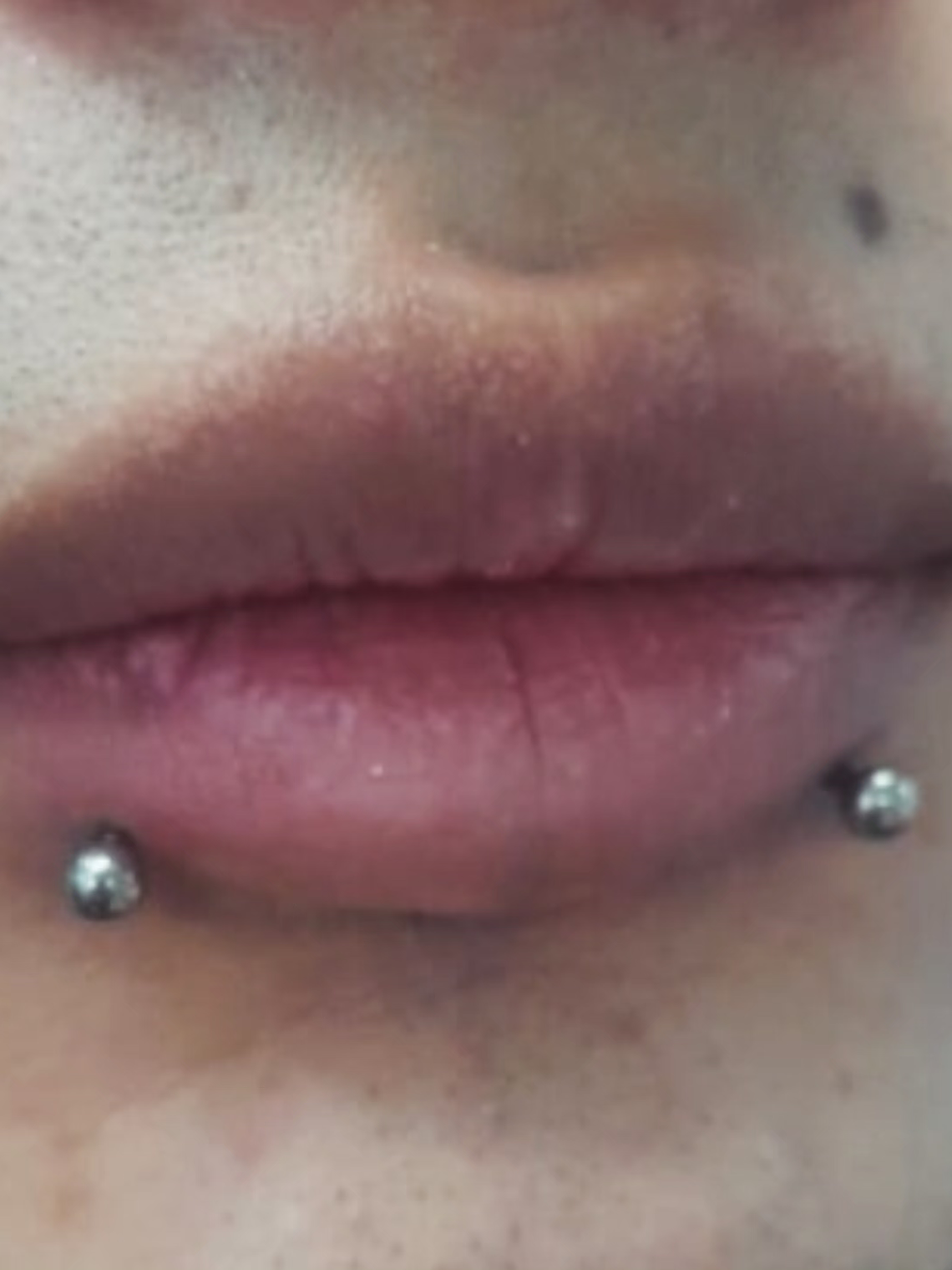 Perforación snake bite , (esferas o puntas 3m) 3