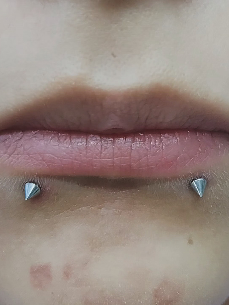 Perforación snake bite , (esferas o puntas 3m) 5