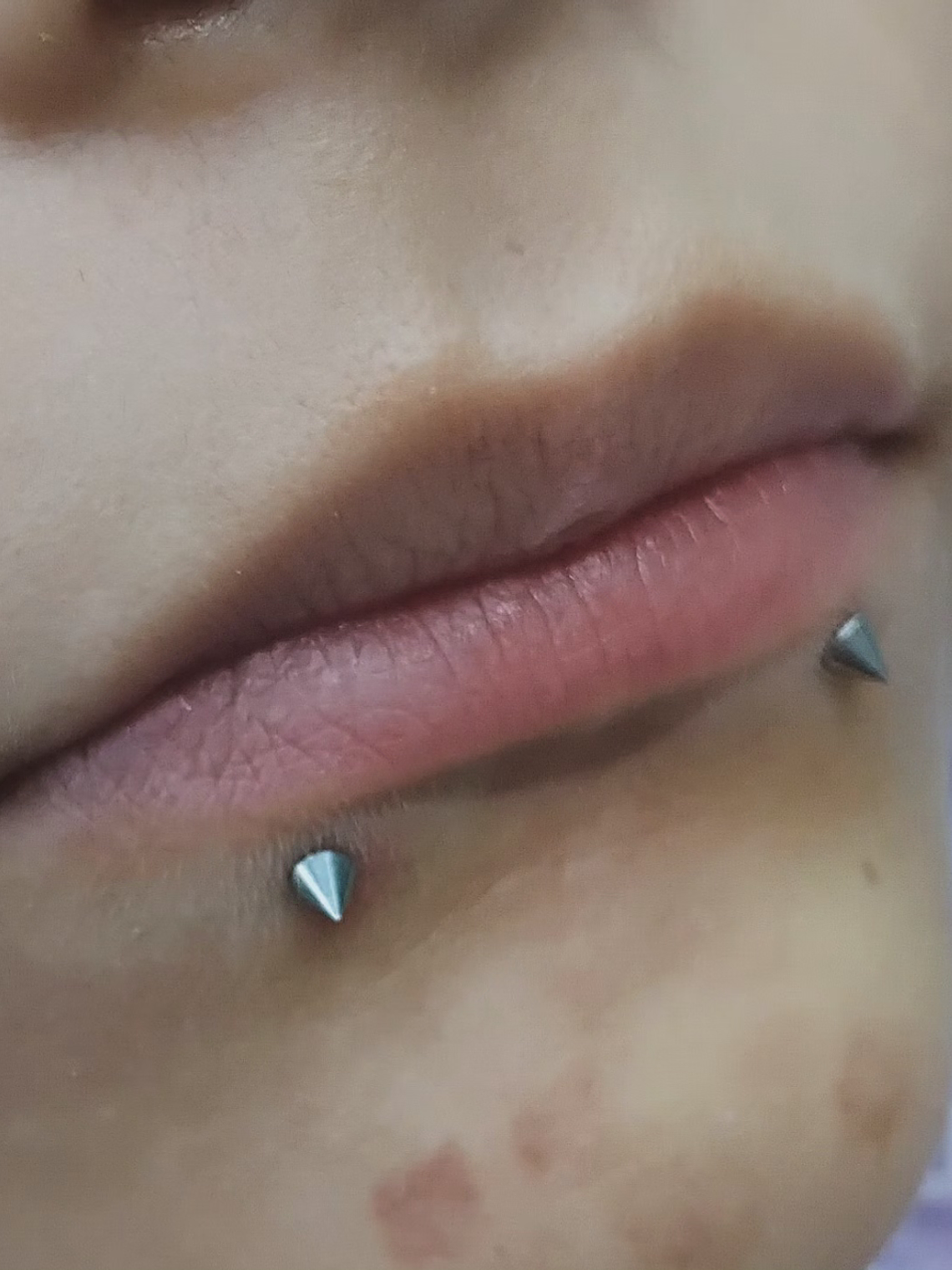 Perforación snake bite , (esferas o puntas 3m) 6