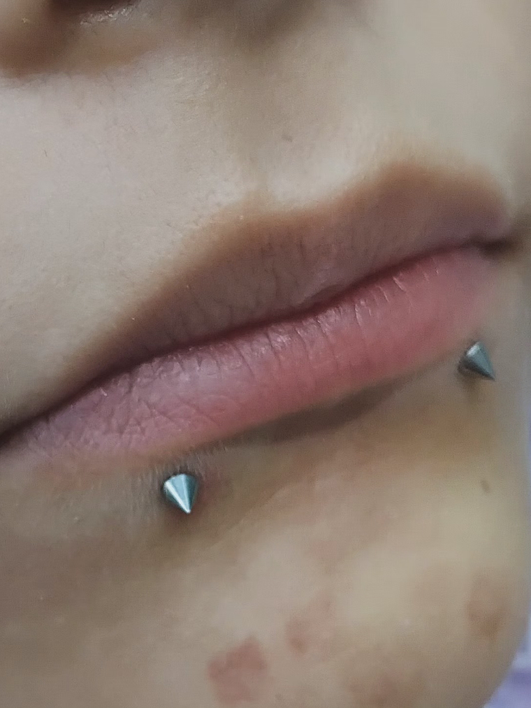 Perforación snake bite , (esferas o puntas 3m) 6