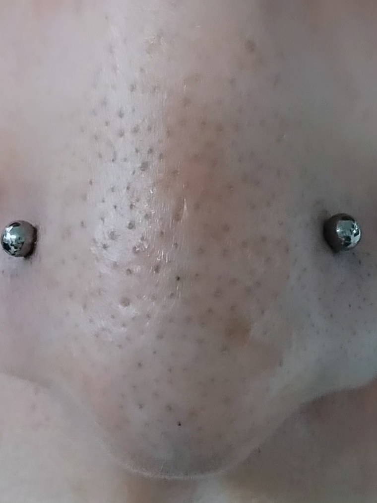 Perforación Doble nostril (simetría) titanio grado implantes (16g) 1