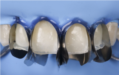 MATRIZ ÚNICA ANTERIOR MINI DEEP 12 UNID. 3