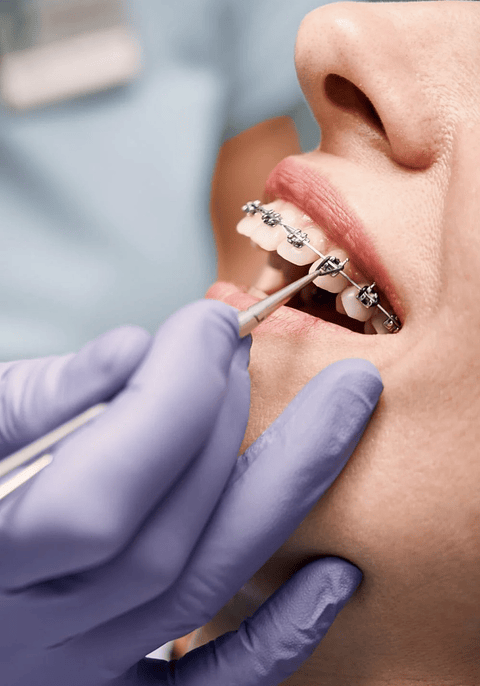 Inicio tratamiento de ortodoncia