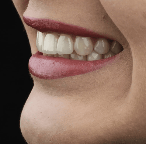 Carillas dentales (desde 8 unidades)