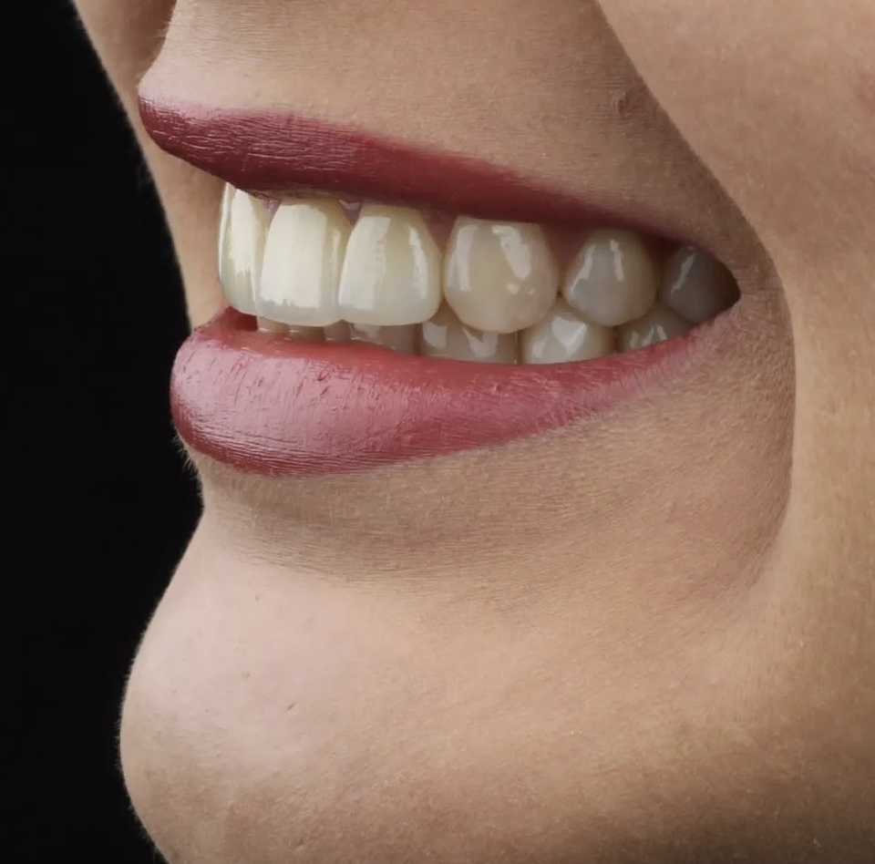 Carillas dentales (desde 8 unidades) 1