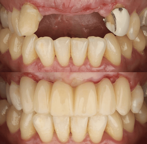 Coronas dentales (desde 6 unidades)