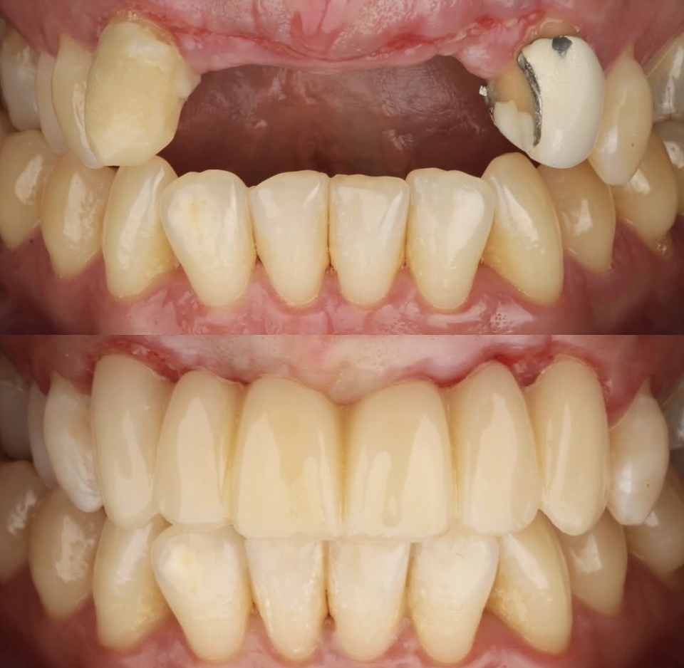 Coronas dentales (desde 6 unidades) 1