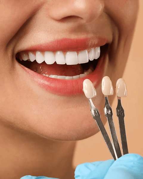 Blanqueamiento dental + limpieza