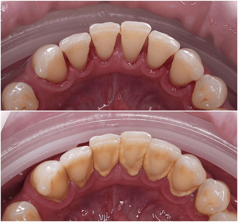 Destartraje + limpieza + radiografía