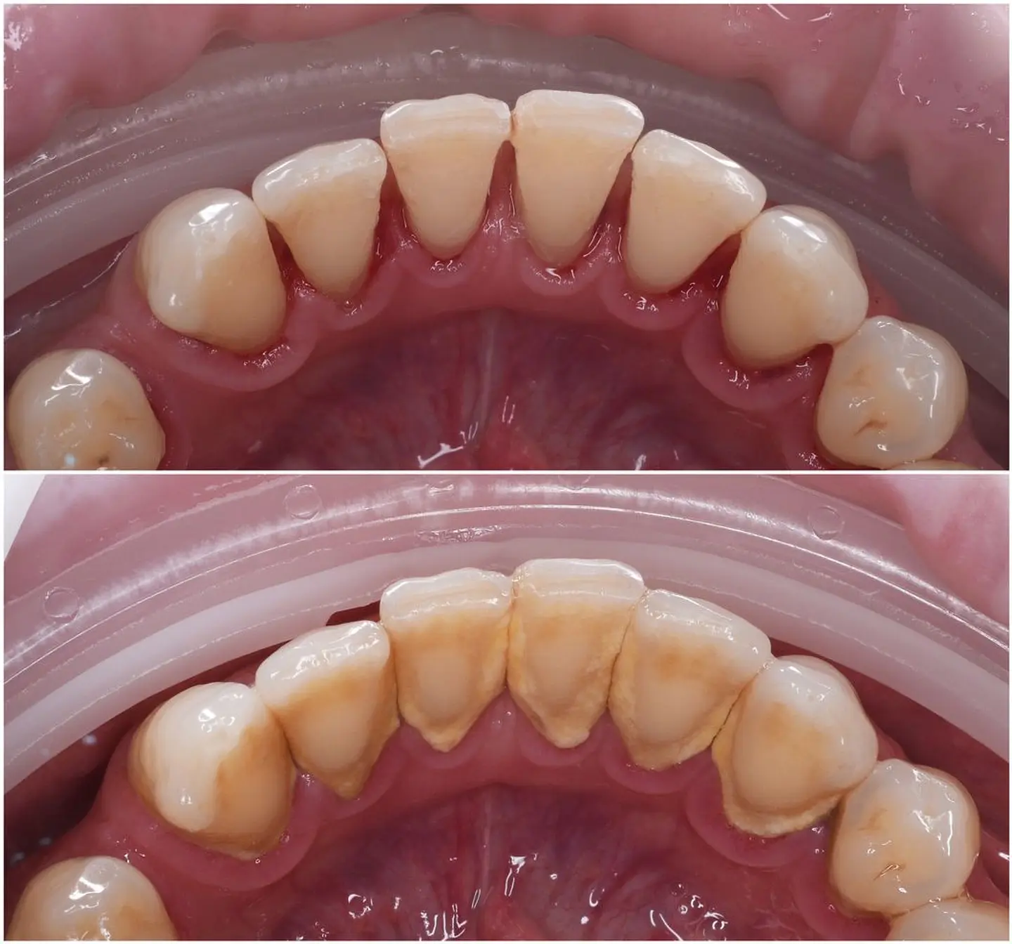 Destartraje + limpieza + radiografía 1