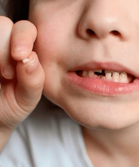 Extracción de diente de leche (niños)
