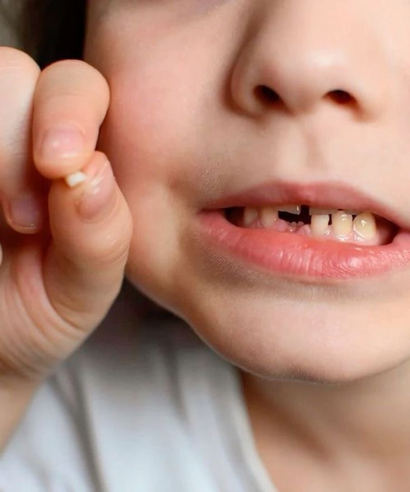 Extracción de diente de leche (niños) 1