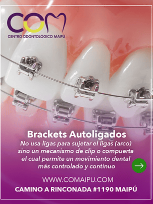 brackets autoligados