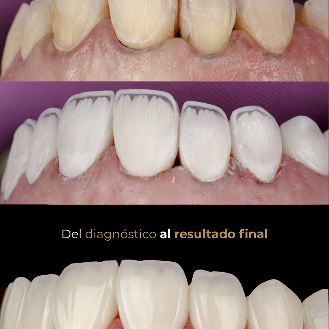 Stratify Internacional: Diseño de Sonrisa en Carillas de Resina Estratificadas 4