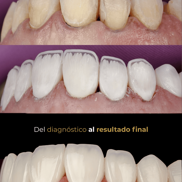 Stratify Internacional: Diseño de Sonrisa en Carillas de Resina Estratificadas 4