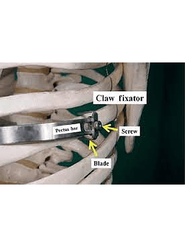 Corrección Pectus Excavatum con Park System