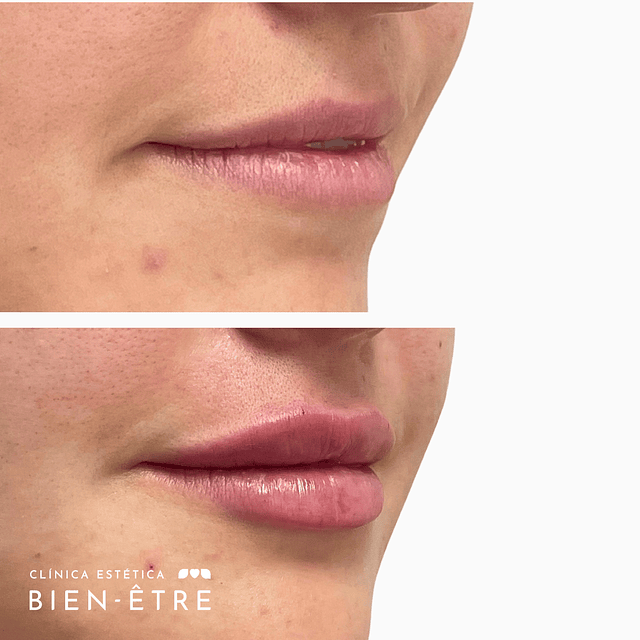 Hidratación o relleno de Labios