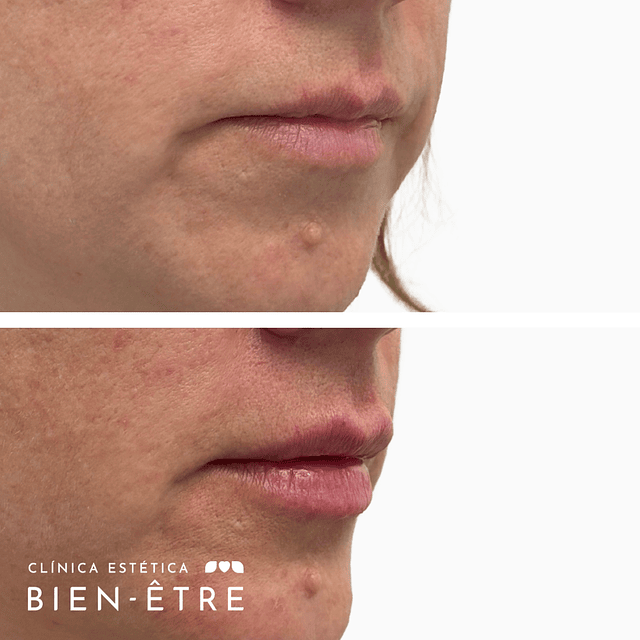 Hidratación o relleno de Labios