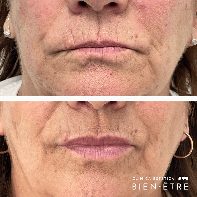 Hidratación o relleno de Labios