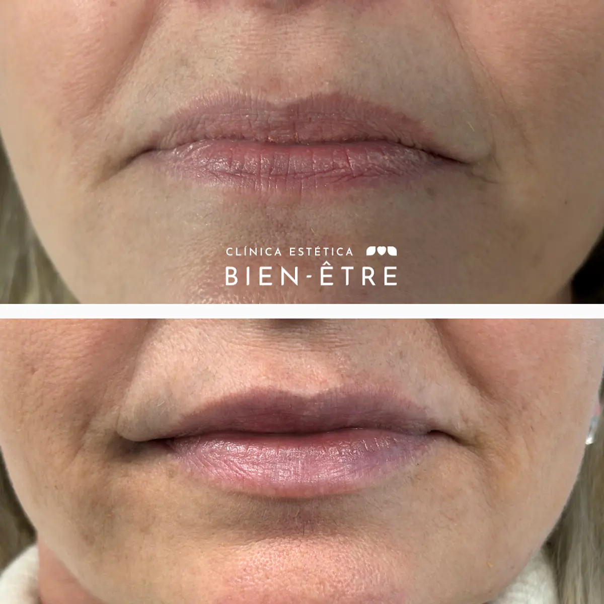 Relleno de Labios