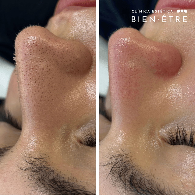 Limpieza Facial Profunda