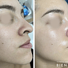 6x Limpieza Facial Profunda