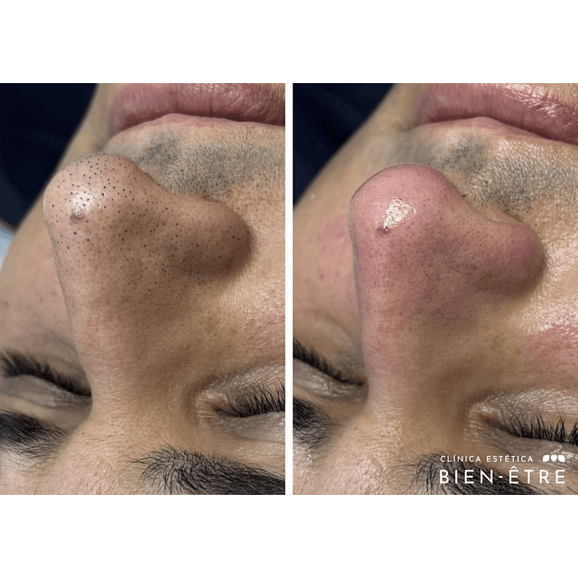 Plan anual de Limpiezas faciales