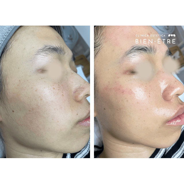 Plan Vitaminas Glow Natural (4 sesiones)