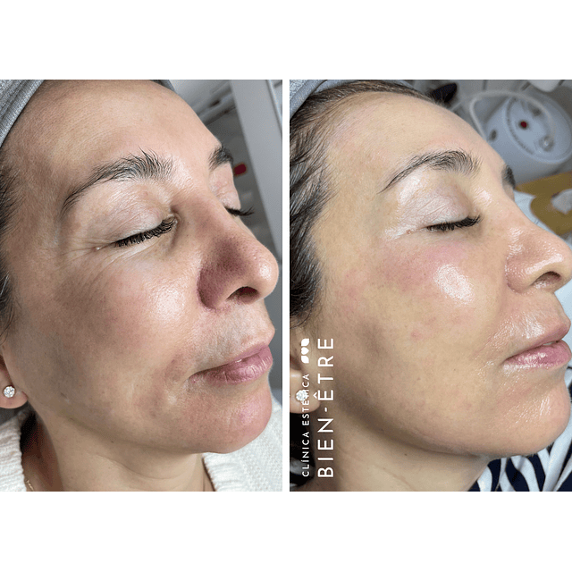 Plan Vitaminas Glow Natural (4 sesiones)