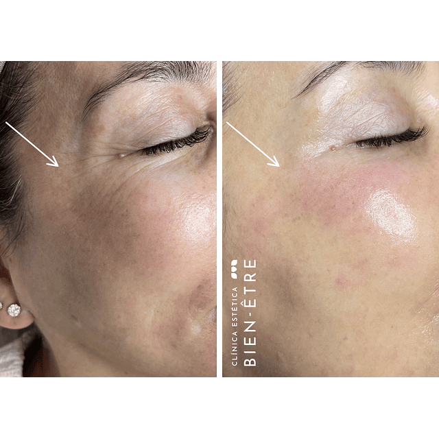 Plan Vitaminas Glow Natural (4 sesiones)