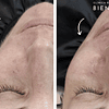 3x Dermaplaning