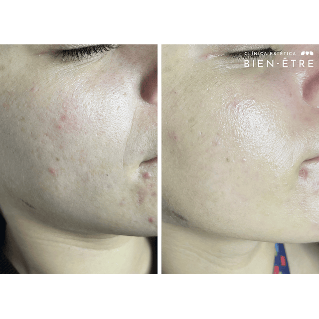 Limpieza Facial Embarazadas