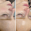 Limpieza Facial Embarazadas