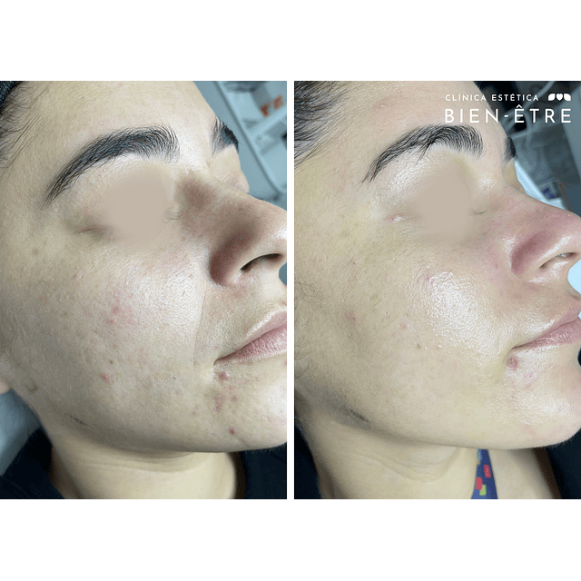 3x Limpieza Facial Embarazadas