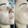3x Limpieza Facial Embarazadas